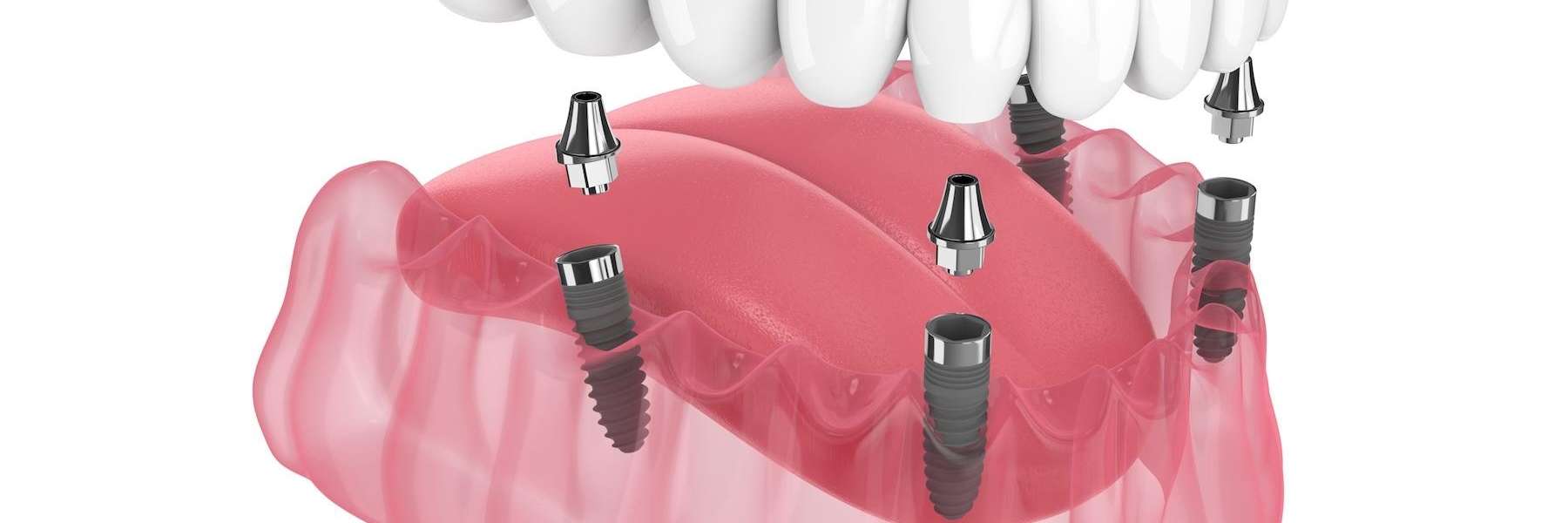 3D illustration of All-on-X dental implants showing multiple implants supporting a full arch of repl