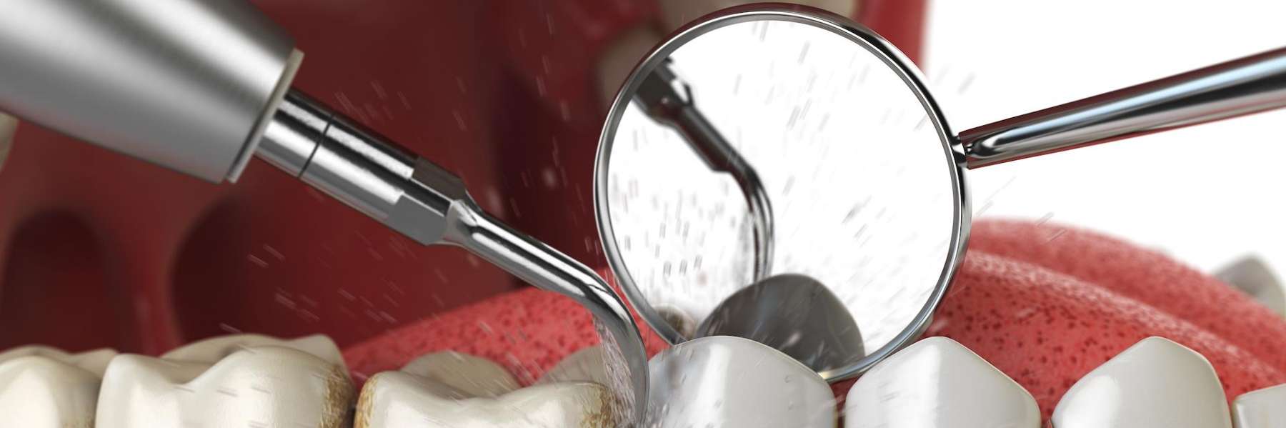 iamge of a teeth cleaning in edwardsville il