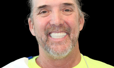 Full-Mouth-Extractions-with-Same-Day-Implant-Placement-and-Fixed-Implant-Dentures-After-Image