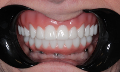 Full-Mouth-Extractions-with-Same-Day-Implants-and-Fixed-Implant-Dentures-After-Image