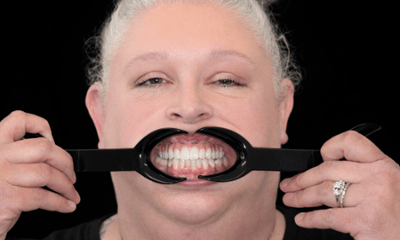 Lower-Extractions-with-Same-Day-Implants-and-Fixed-Upper-Implant-Denture-After-Image