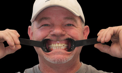 Lower-Full-Arch-Implants-with-Same-Day-Fixed-Teeth-After-Image