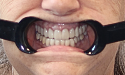 Upper-Front-Crowns-with-Sedation-Dentistry-After-Image
