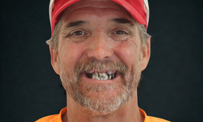 Full-Mouth-Extractions-with-Same-Day-Implant-Placement-and-Fixed-Implant-Dentures-Before-Image