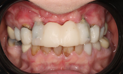 Full-Mouth-Extractions-with-Same-Day-Implants-and-Fixed-Implant-Dentures-Before-Image