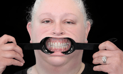 Lower-Extractions-with-Same-Day-Implants-and-Fixed-Upper-Implant-Denture-Before-Image