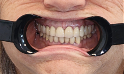 Upper-Front-Crowns-with-Sedation-Dentistry-Before-Image