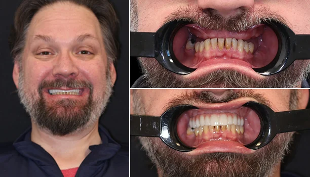 Before and after smile makeover of a man with a beard