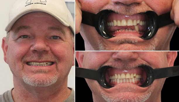 Before and after smile makeover of a man in a baseball cap