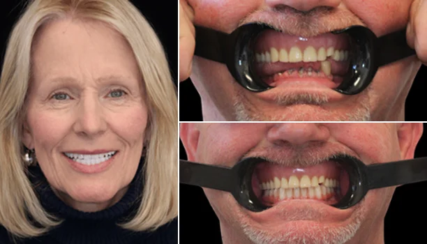 Before and after smile makeover of a woman with blonde hair