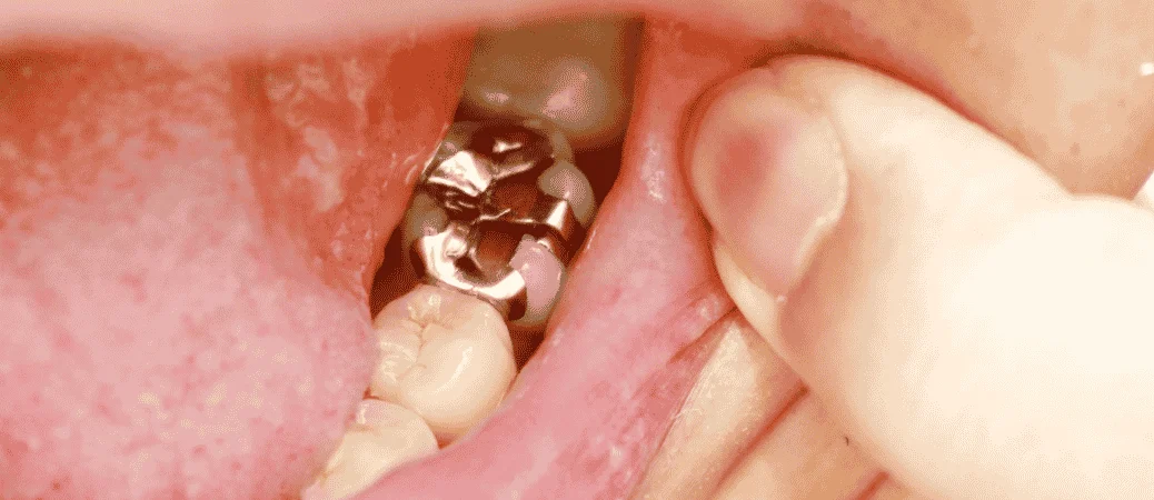 The Lifespan of Modern Dental Restorations: What the Research Shows