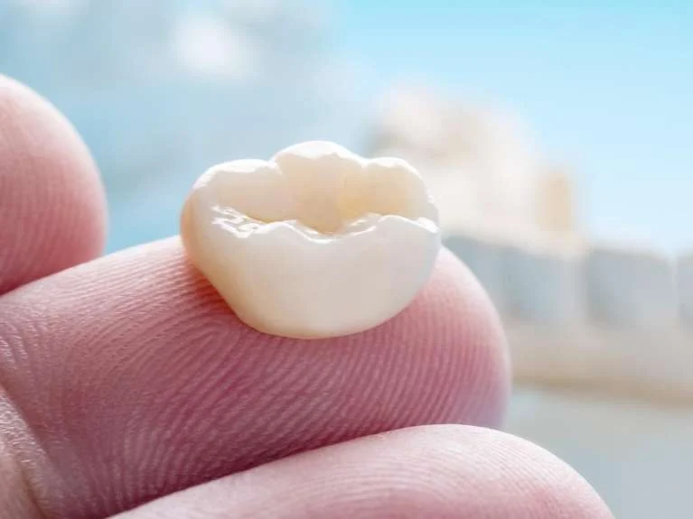 FAQ About Same Day Crowns: Answers to 5 of Your Common Questions