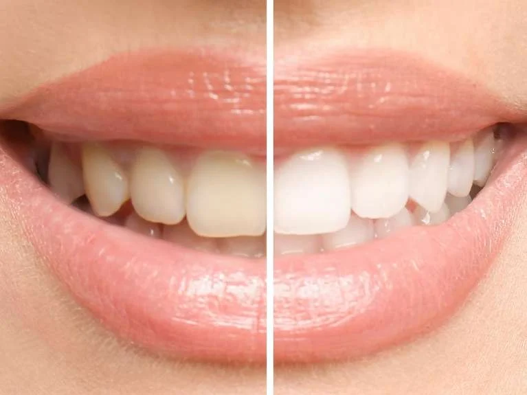 Medium Reclaim-Your-Smile-With-Teeth-Whitening-In-Edwardsville-Il